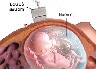 Phương pháp chọc hút nước ối 